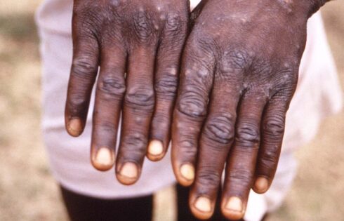 Monkeypox spreads to 12 African countries, Uganda on high alert