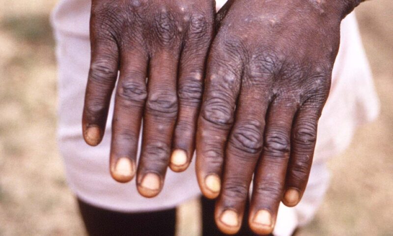 Monkeypox spreads to 12 African countries, Uganda on high alert